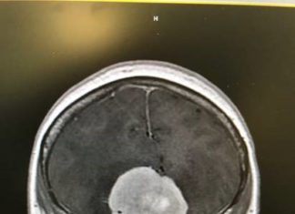 An mri image of a person's head.