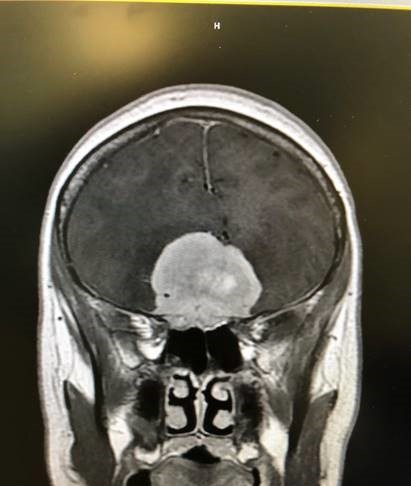 An mri image of a person's head.